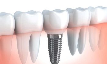implantate